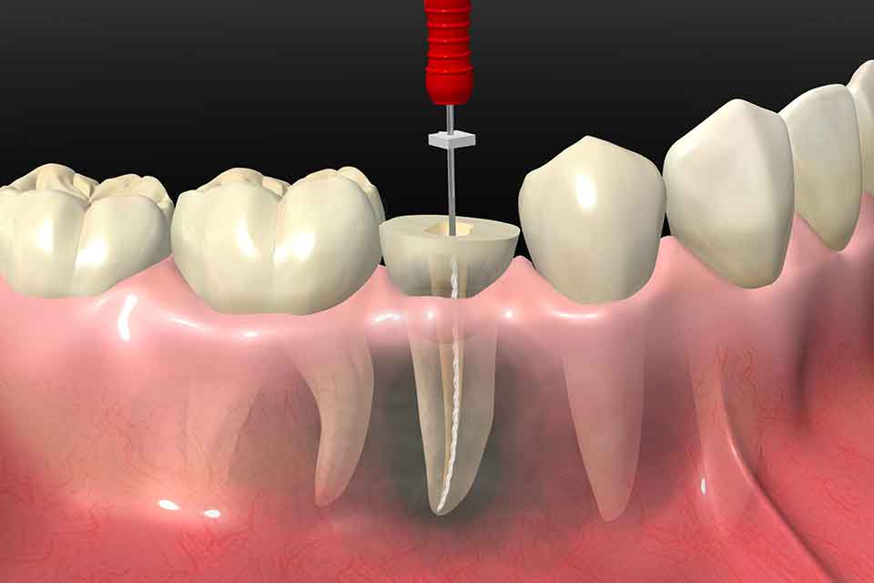 Endodontics (Root Canal Treatment)